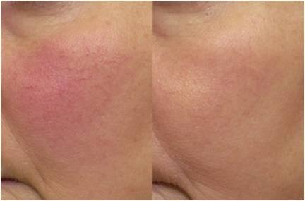 Couperose prima e dopo il trattamento con Laser KTP 532nm