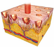 Laser ablativo frazionale